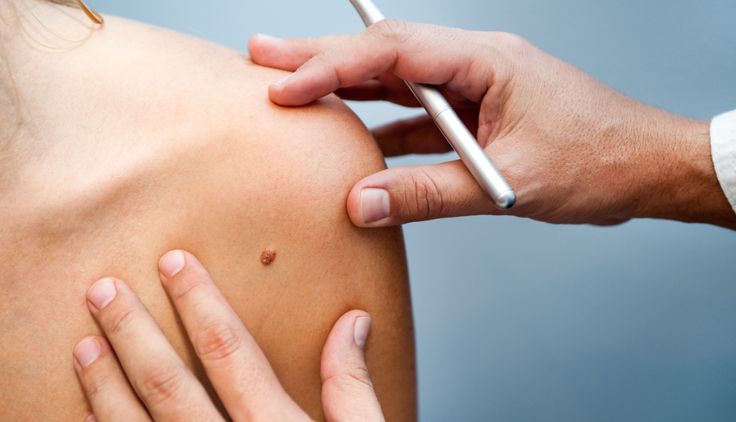Nuevas investigaciones sobre cáncer de piel en poblaciones mexicanas: implicaciones clínicas