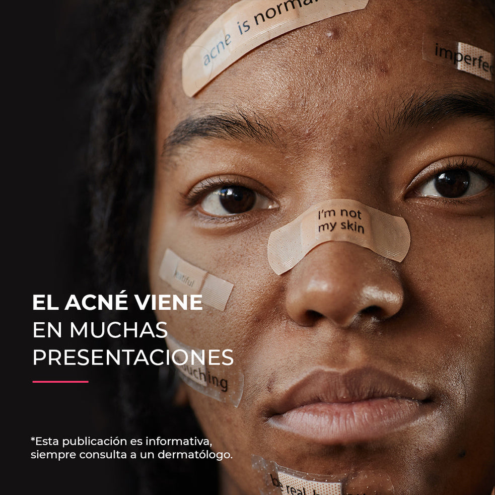 Hiperpigmentación postinflamatoria: ¿Por qué te quedan manchas después del acné?